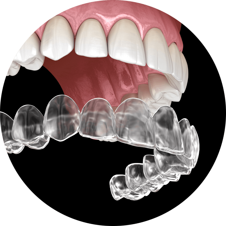 invisalign model